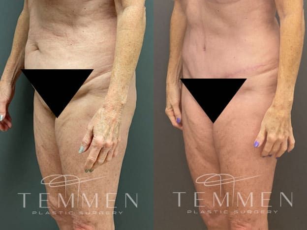 Tummy Tuck Before & After