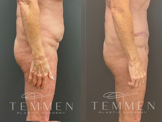 Tummy Tuck Before & After