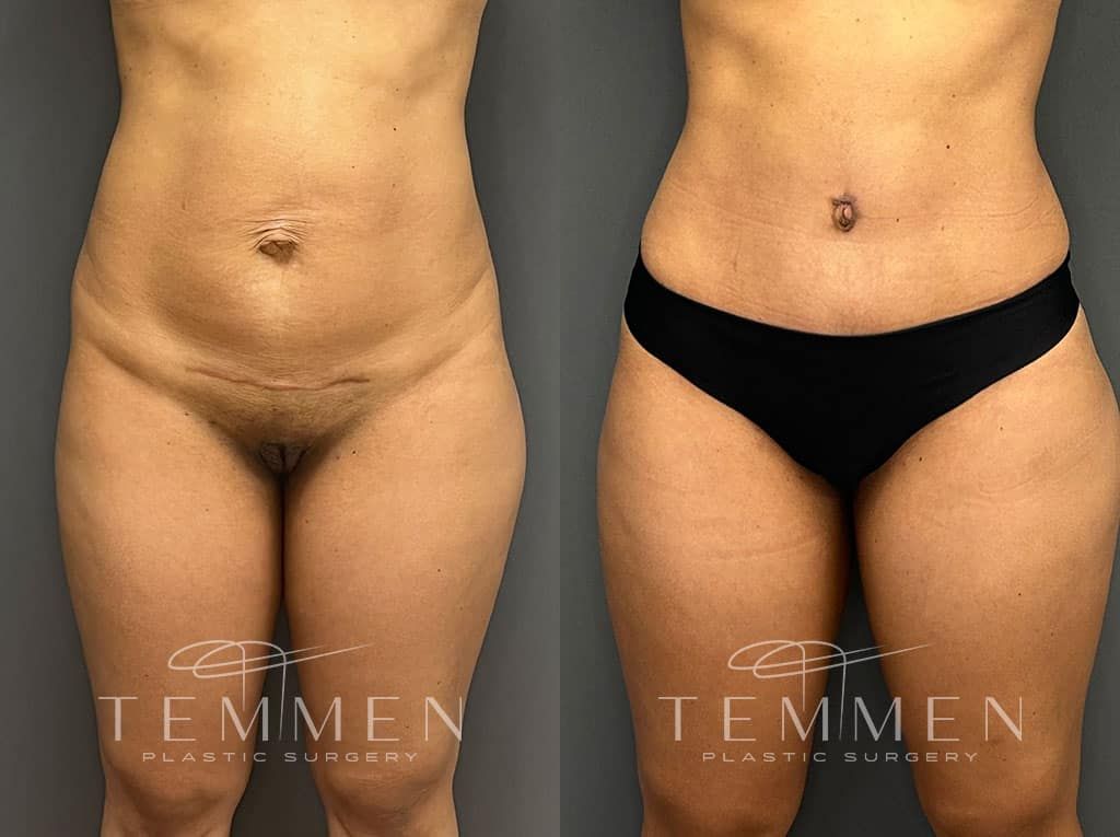 Tummy Tuck Before & After