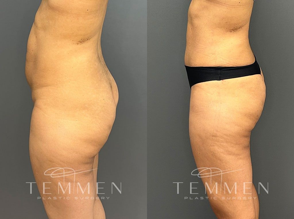 Tummy Tuck Before & After