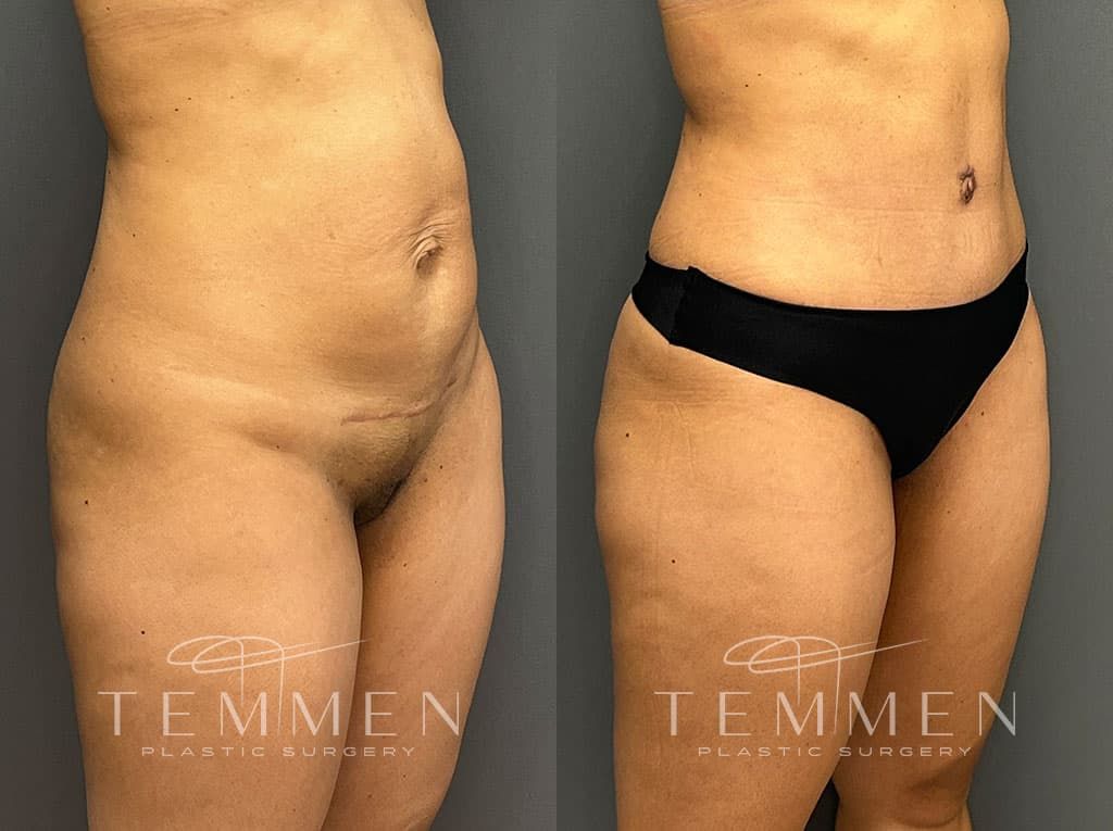 Tummy Tuck Before & After