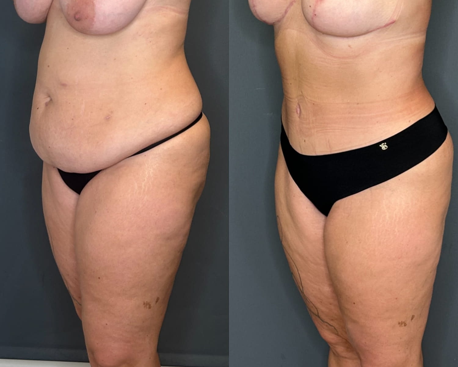 Tummy Tuck Before & After