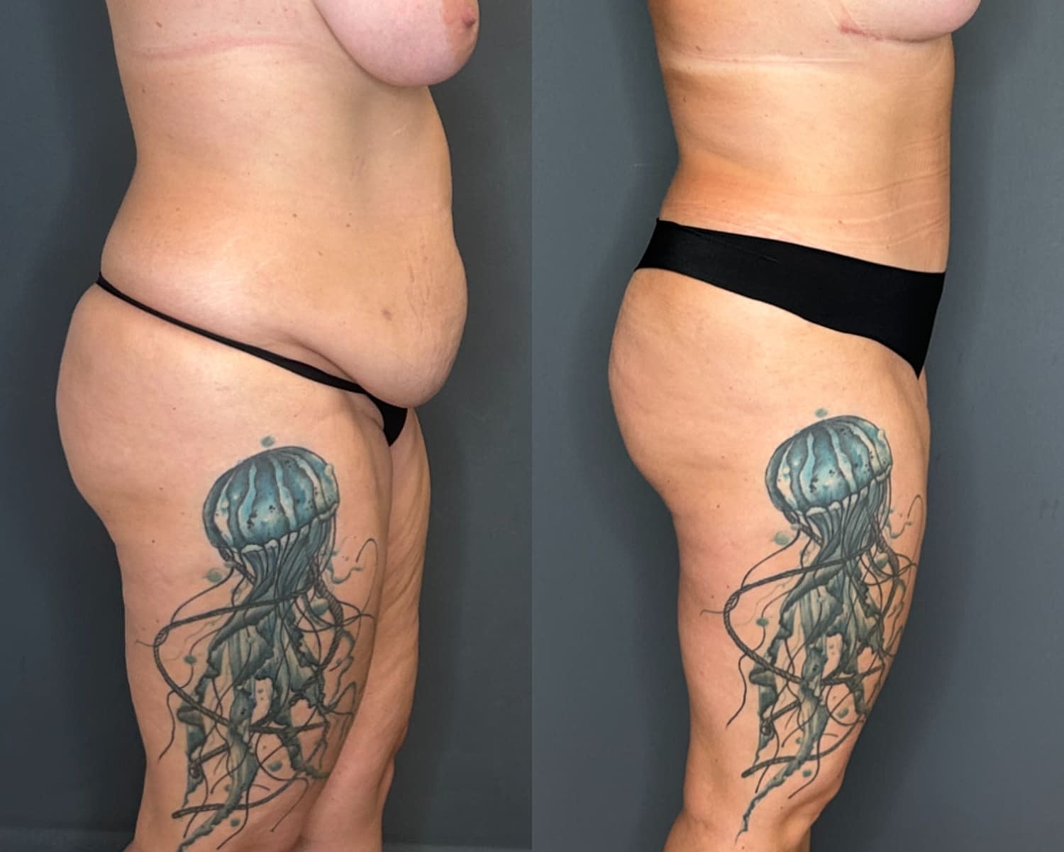 Tummy Tuck Before & After