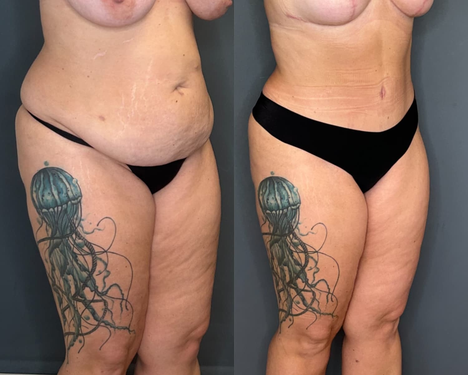 Tummy Tuck Before & After