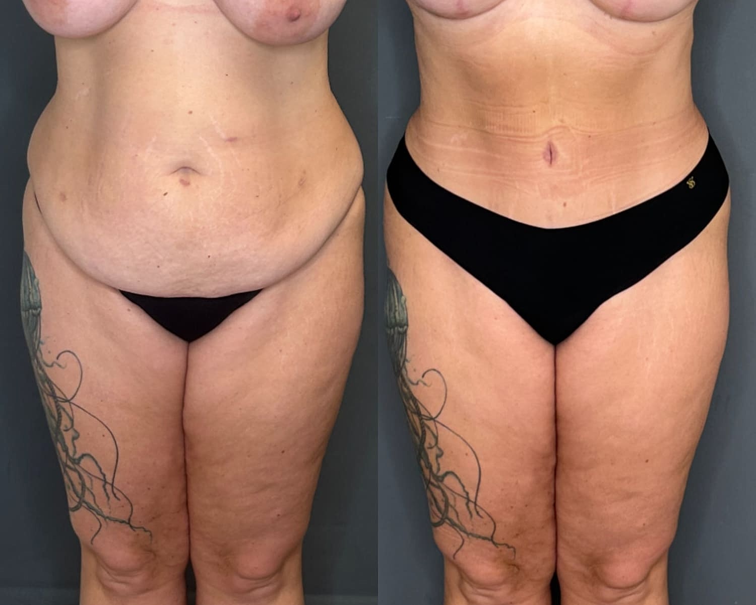Tummy Tuck Before & After