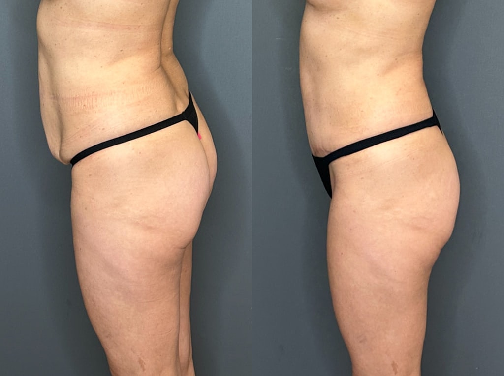 Tummy Tuck Before & After