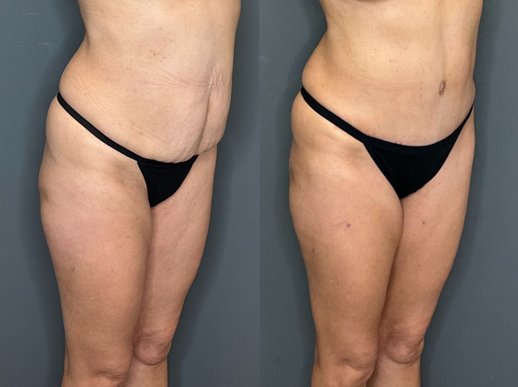 Tummy Tuck Before & After