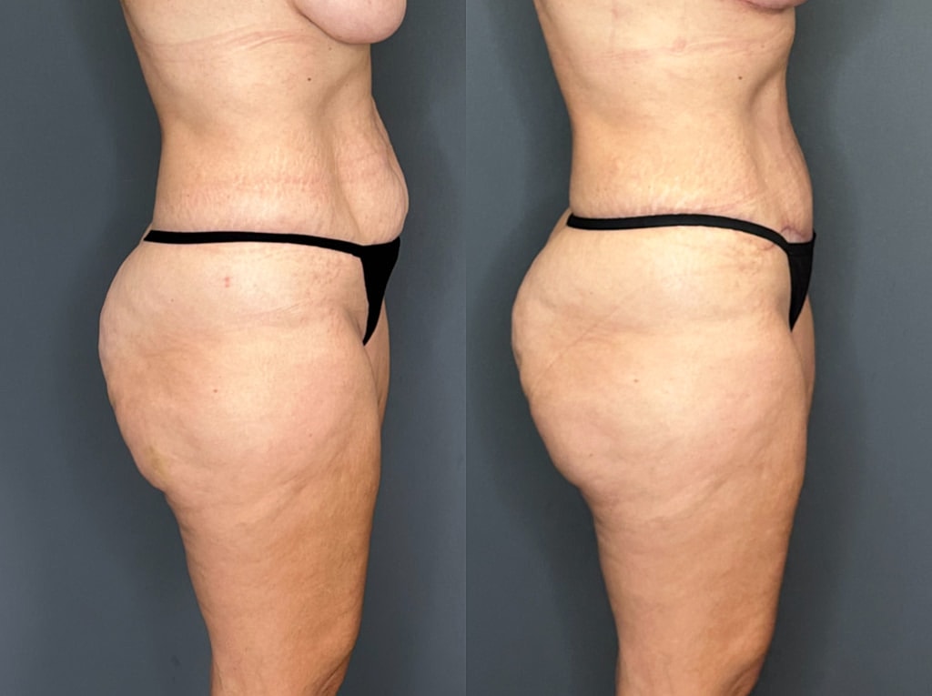 Tummy Tuck Before & After