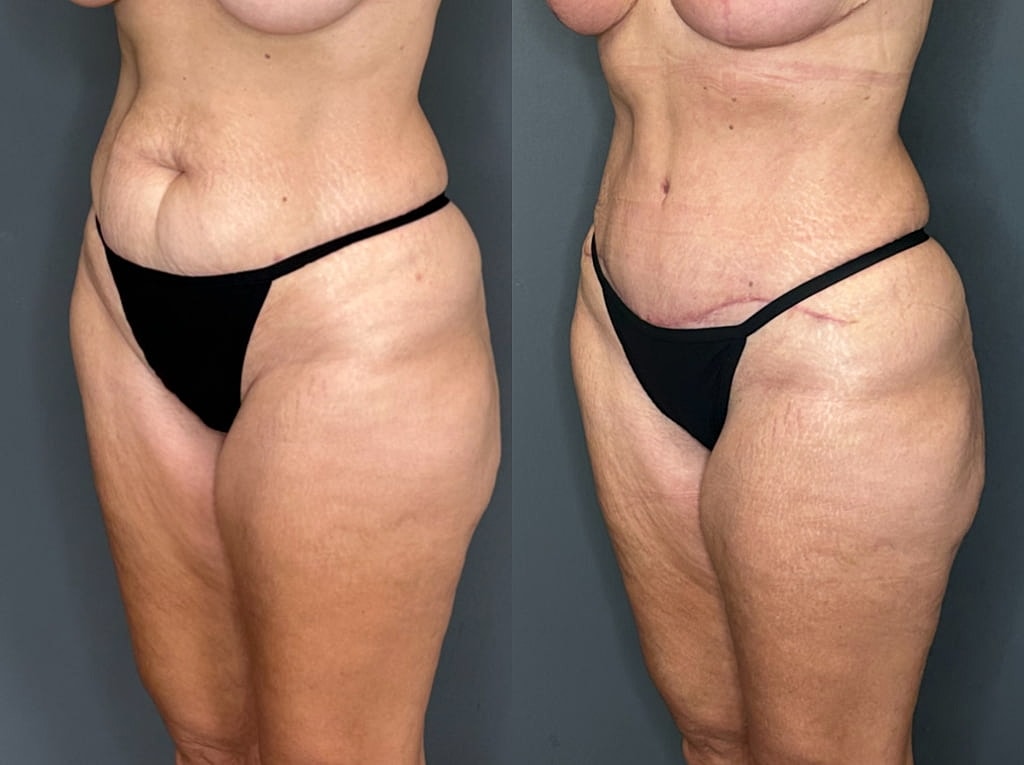 Tummy Tuck Before & After