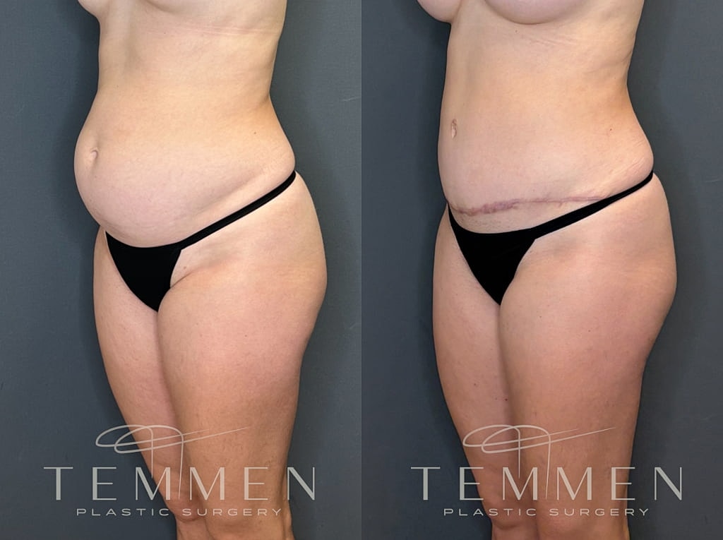 Tummy Tuck Before & After
