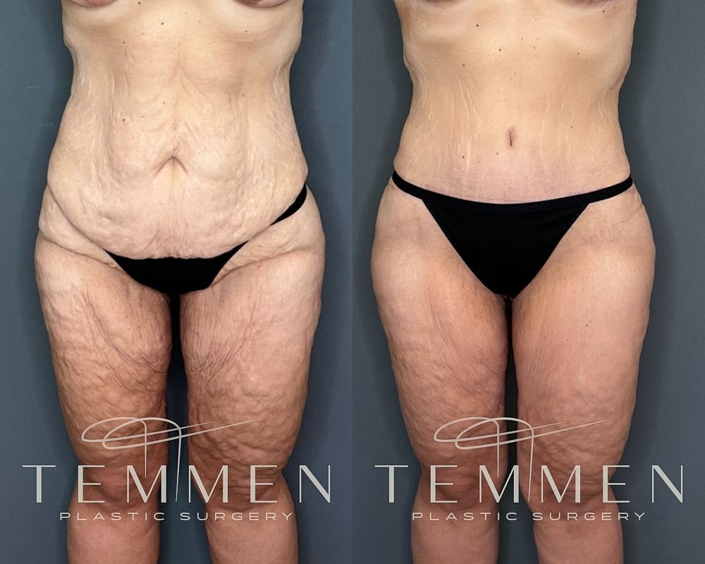 Tummy Tuck Before & After