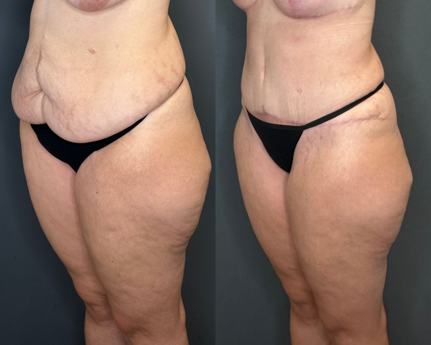 Tummy Tuck Before & After