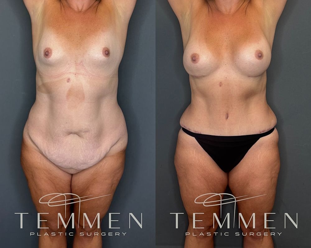 Before and after plastic surgery transformation.