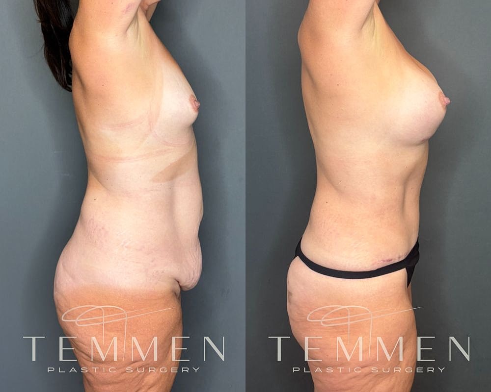 Before and after body contouring transformation.