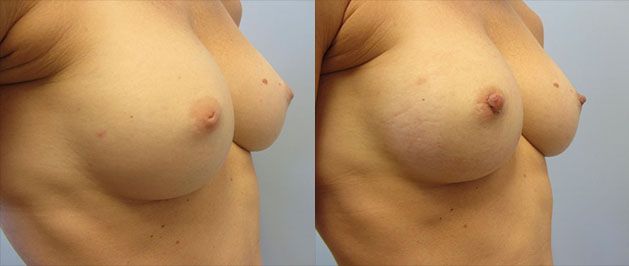 Nipple Inversion Correction Before & After