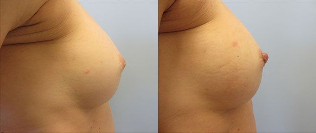 Nipple Inversion Correction Before & After