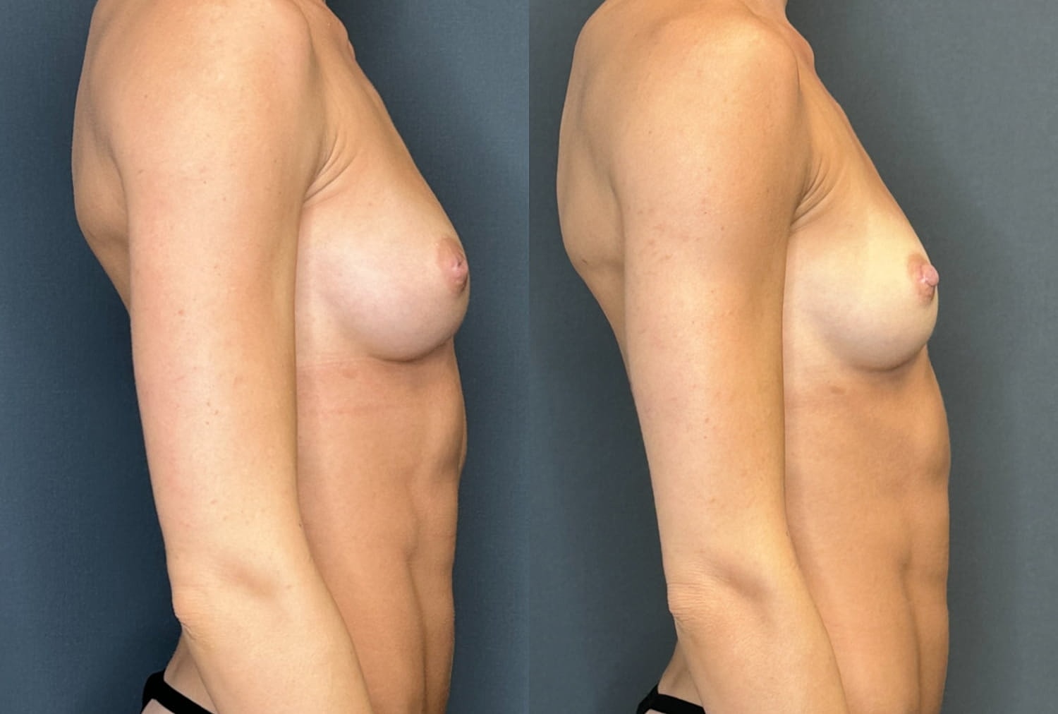 Nipple Inversion Correction Before & After
