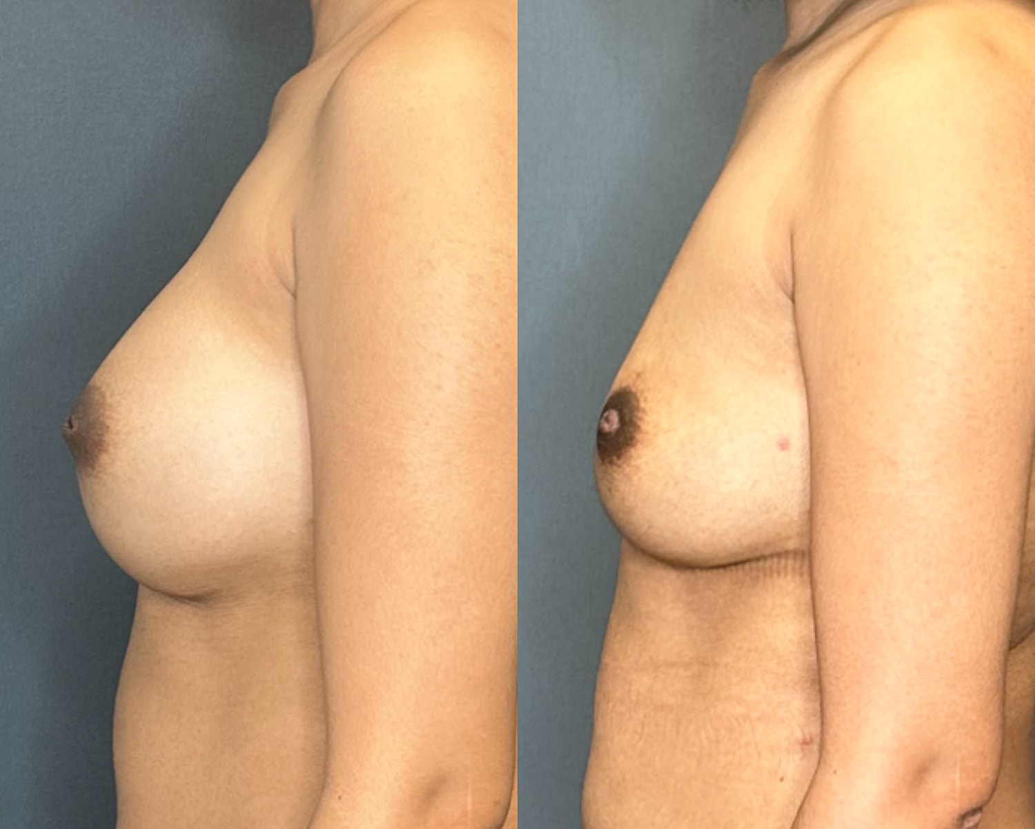 Nipple Inversion Correction Before & After