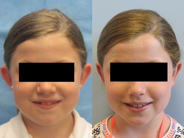 Ear Surgery Before & After