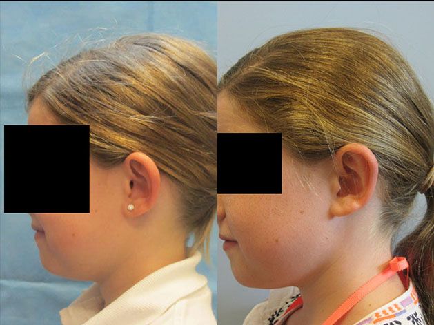 Ear Surgery Before & After