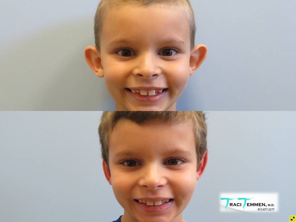 Ear Surgery Before & After