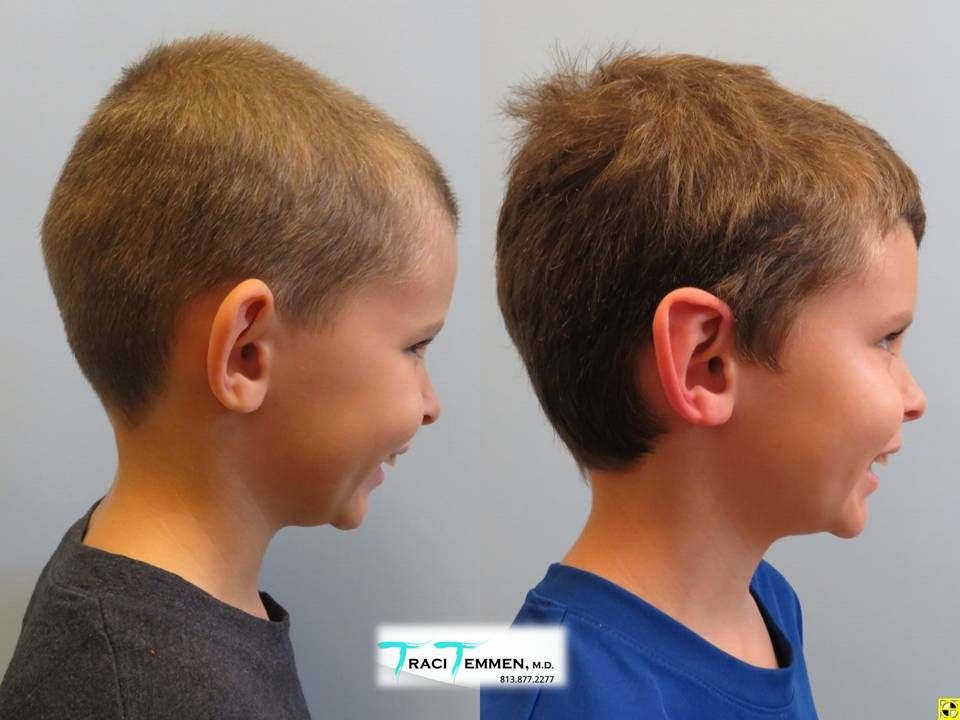 Ear Surgery Before & After