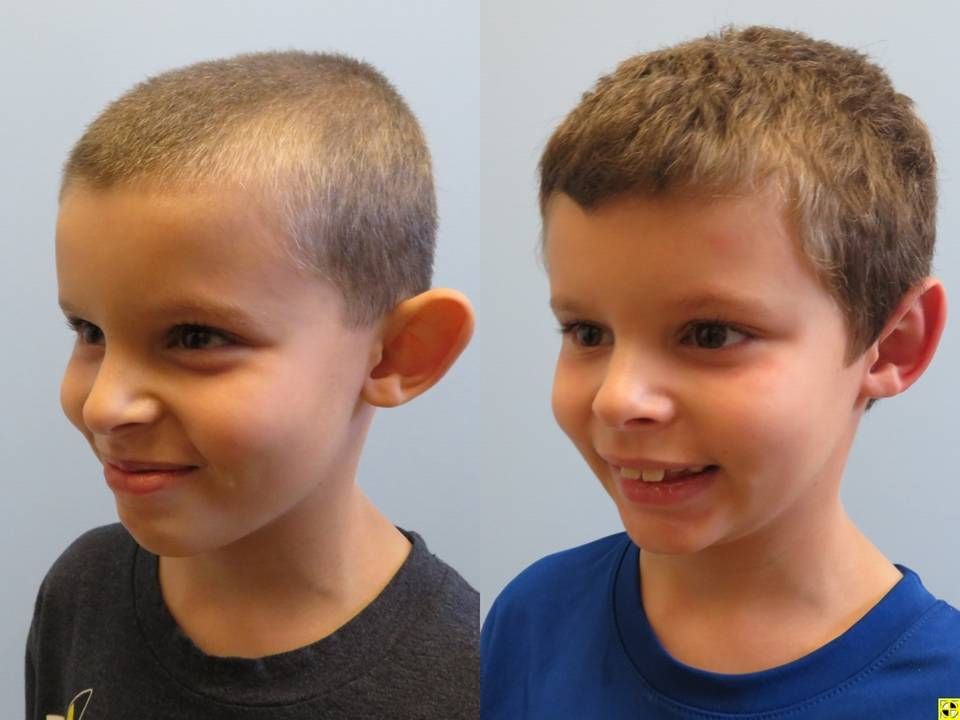 Ear Surgery Before & After