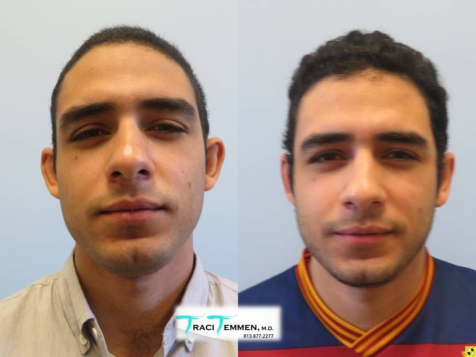 Ear Surgery Before & After