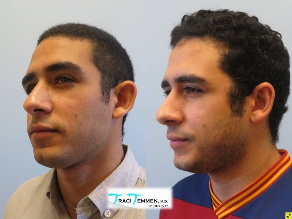 Ear Surgery Before & After