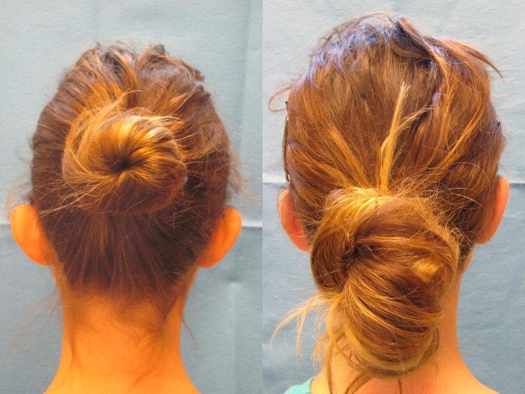 Ear Surgery Before & After