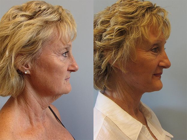 Face Fat Grafting Before & After