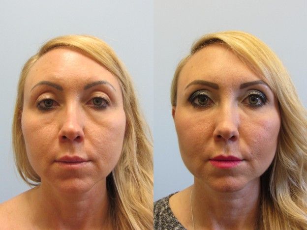 Face Fat Grafting Before & After