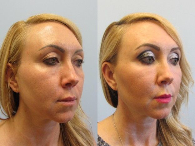 Face Fat Grafting Before & After