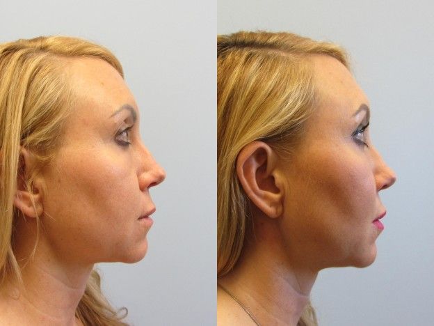 Face Fat Grafting Before & After