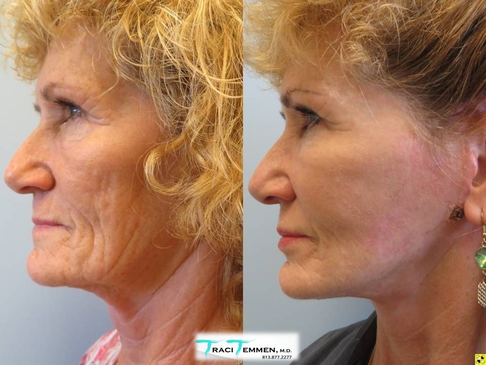Face Fat Grafting Before & After