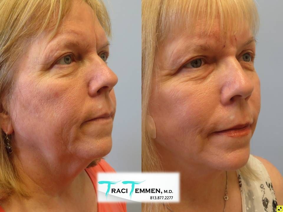 Face Fat Grafting Before & After