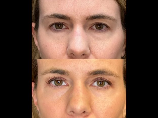 Face Fat Grafting Before & After
