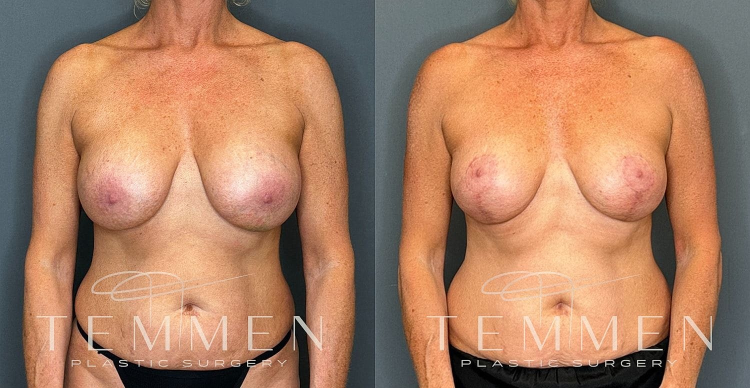 Before and after breast augmentation surgery results