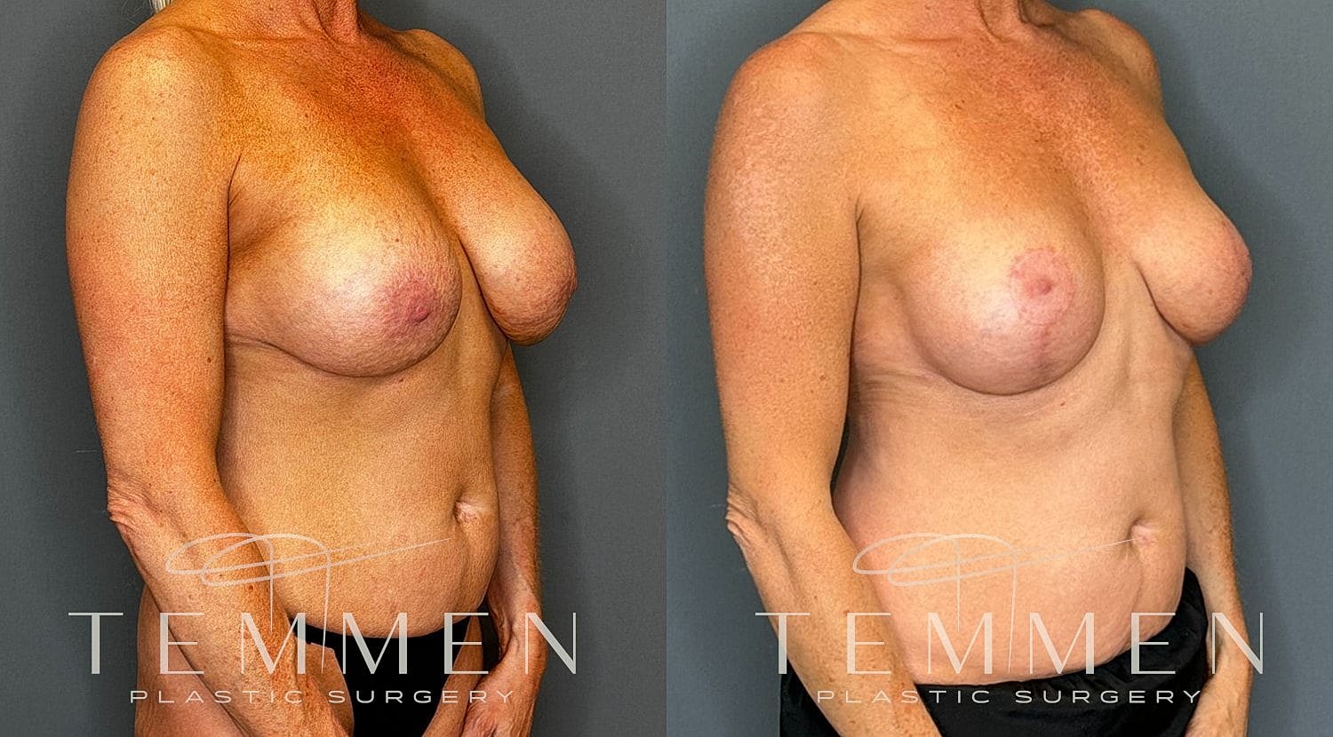 Before and after breast enhancement surgery results