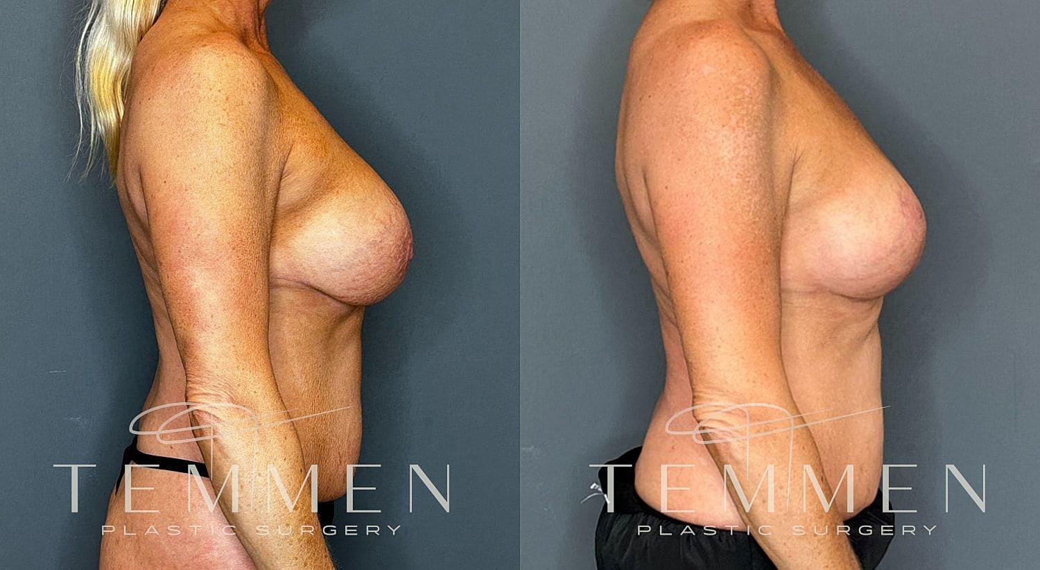 Before and after plastic surgery side profile comparison.