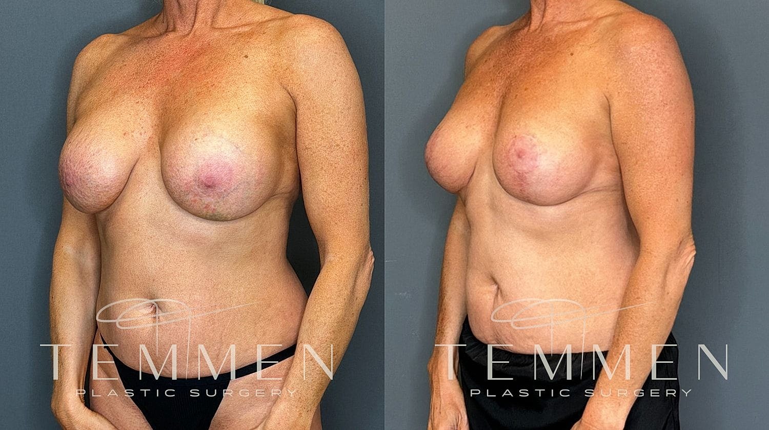 Before and after breast augmentation side view