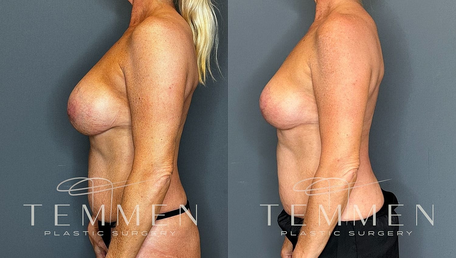 Before and after plastic surgery transformation side view