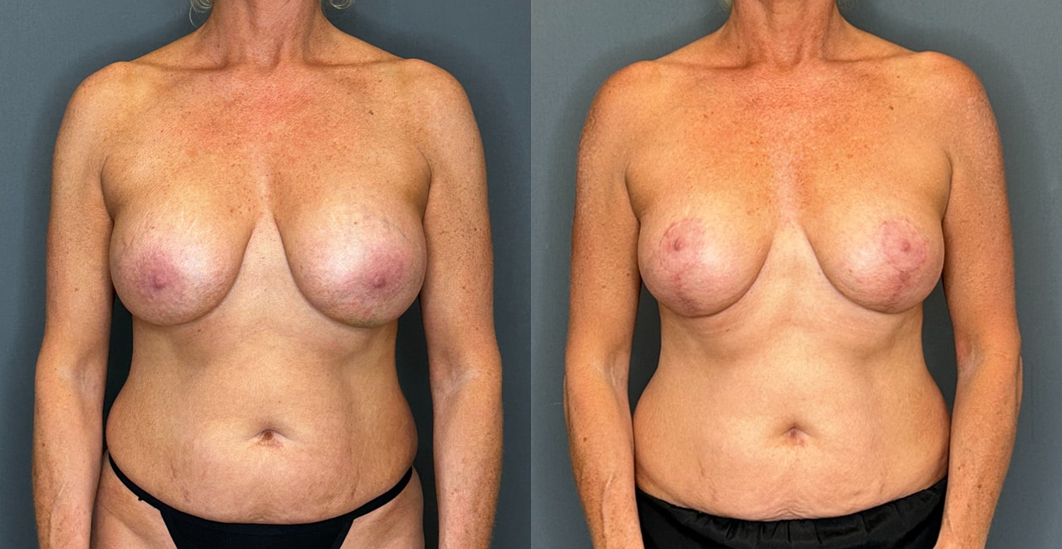 Breast Implant Revision With Lift Before & After