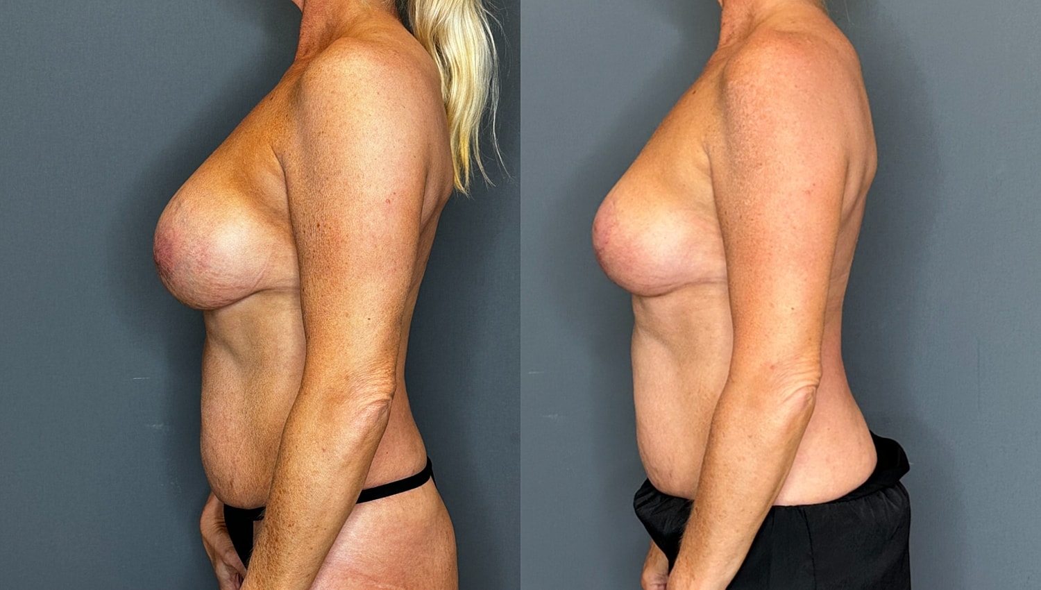 Breast Implant Revision With Lift Before & After
