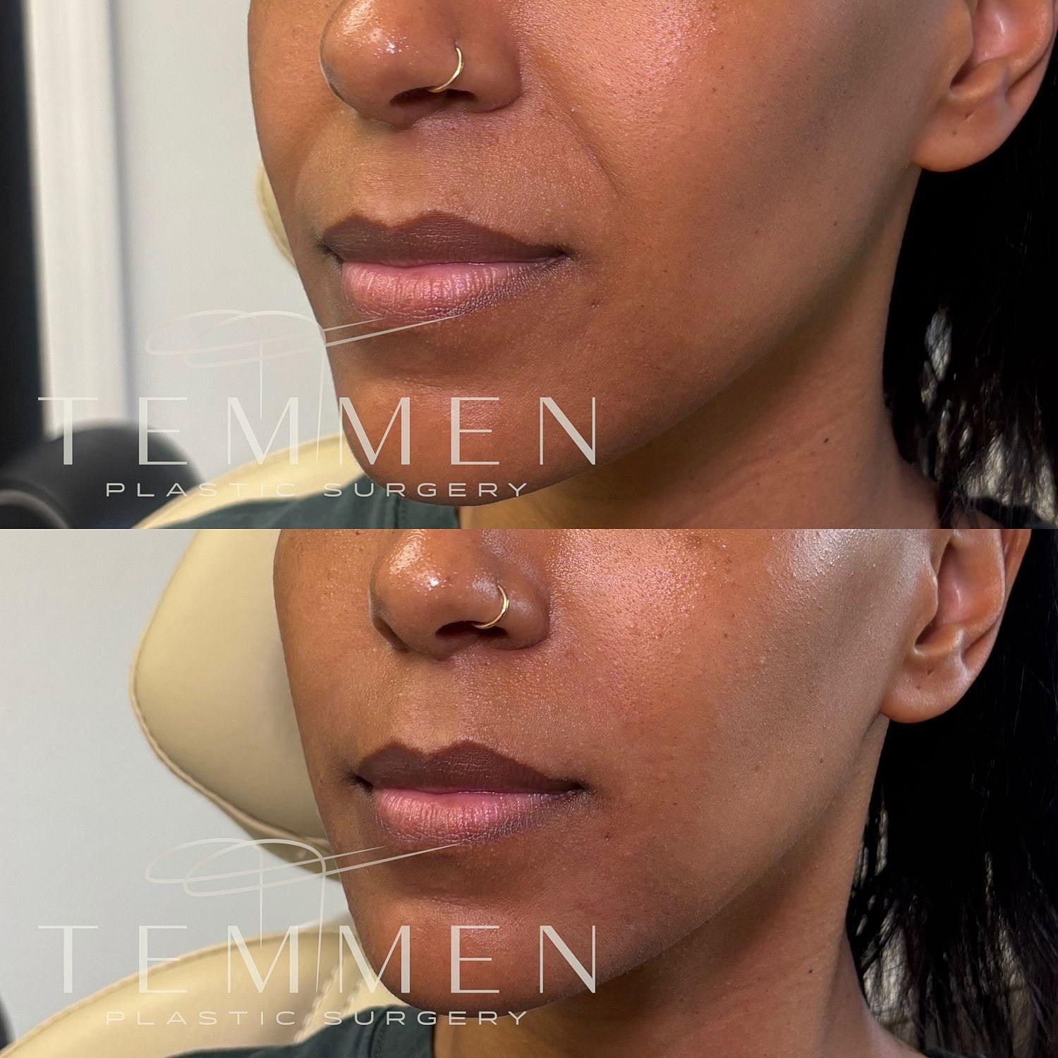 Nasolabial Fold Filler Before & After